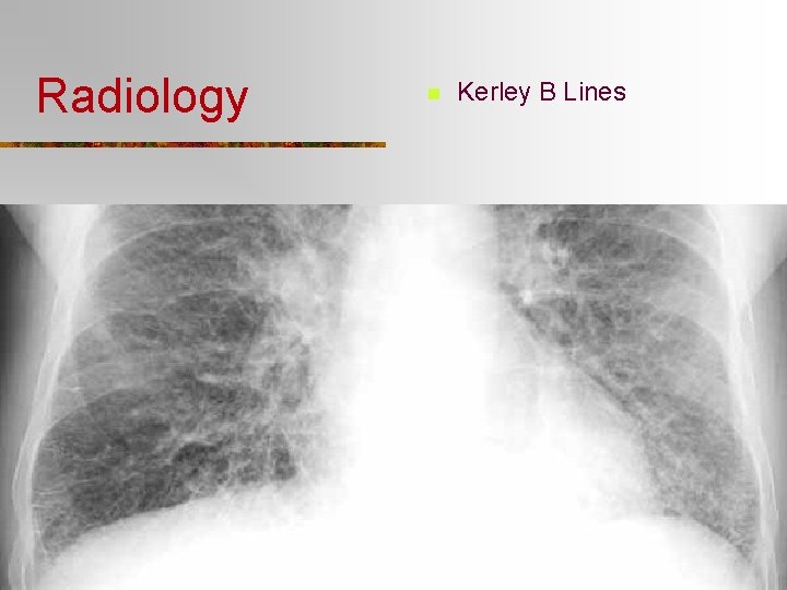 Radiology n Kerley B Lines 