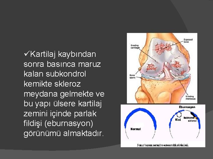 üKartilaj kaybından sonra basınca maruz kalan subkondrol kemikte skleroz meydana gelmekte ve bu yapı