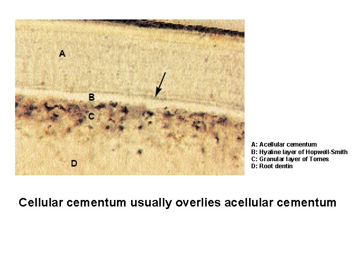 A: Acellular cementum B: Hyaline layer of Hopwell-Smith C: Granular layer of Tomes D: A: Acellular cementum B: Hyaline layer of Hopwell-Smith C: Granular layer of Tomes D: