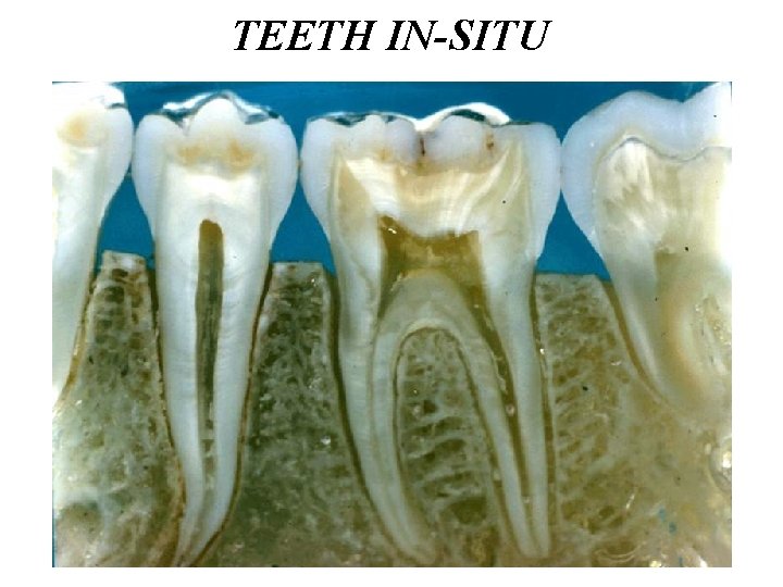 TEETH IN-SITU TEETH IN-SITU