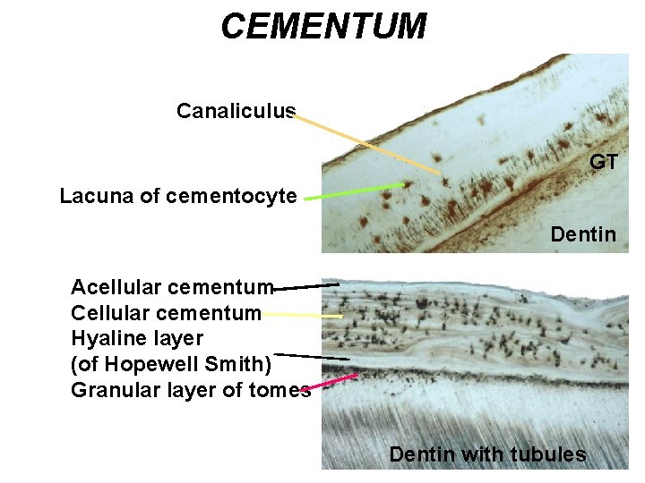 CEMENTUM Canaliculus GT Lacuna of cementocyte Dentin Acellular cementum Cellular cementum Hyaline layer (of CEMENTUM Canaliculus GT Lacuna of cementocyte Dentin Acellular cementum Cellular cementum Hyaline layer (of
