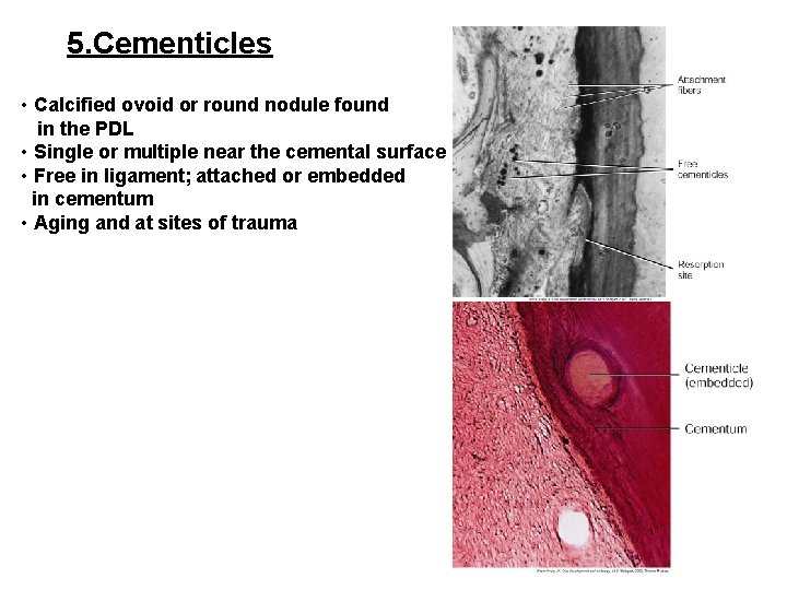5. Cementicles • Calcified ovoid or round nodule found in the PDL • Single 5. Cementicles • Calcified ovoid or round nodule found in the PDL • Single