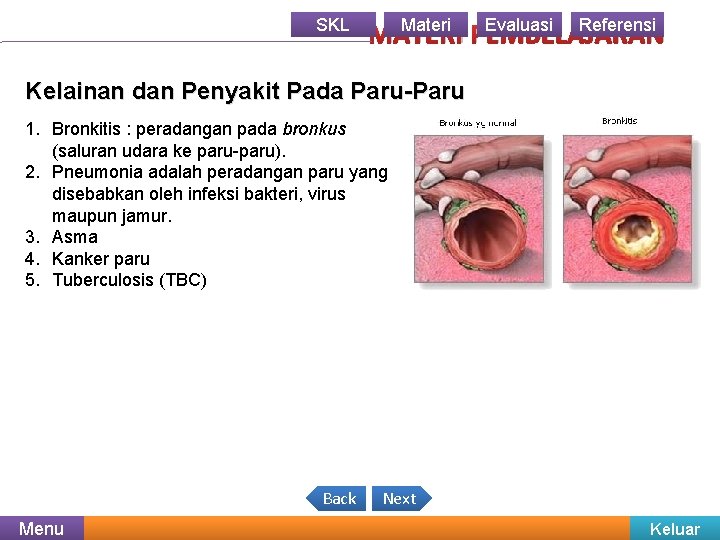 SKL Materi Evaluasi Referensi MATERI PEMBELAJARAN Kelainan dan Penyakit Pada Paru-Paru 1. Bronkitis :