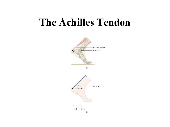The Achilles Tendon 