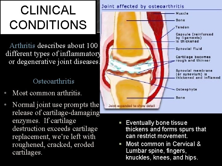 CLINICAL CONDITIONS Arthritis describes about 100 different types of inflammatory or degenerative joint diseases.