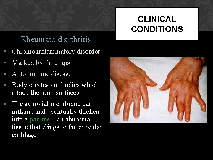 CLINICAL CONDITIONS Rheumatoid arthritis • Chronic inflammatory disorder • Marked by flare-ups • Autoimmune