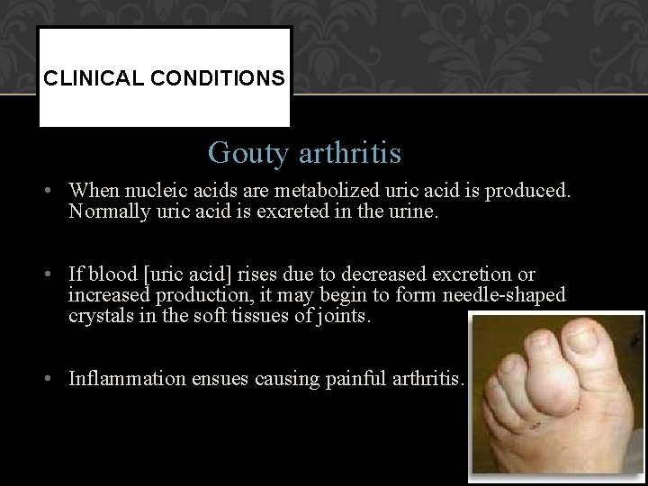 CLINICAL CONDITIONS Gouty arthritis • When nucleic acids are metabolized uric acid is produced.