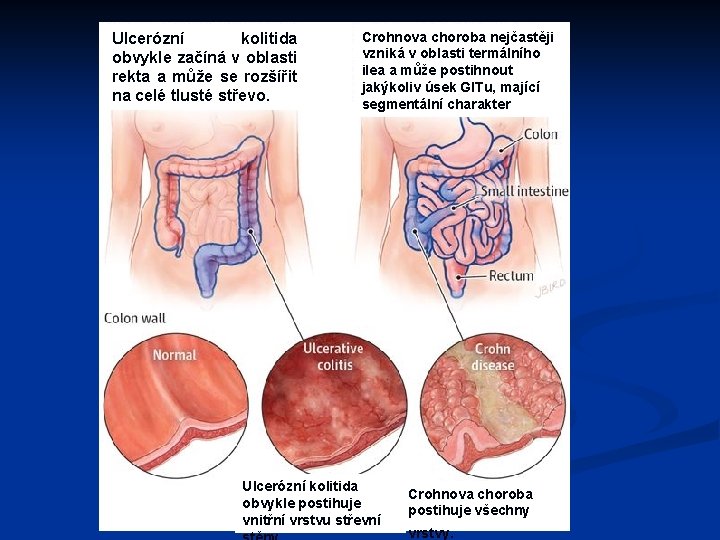 Ulcerózní kolitida obvykle začíná v oblasti rekta a může se rozšířit na celé tlusté