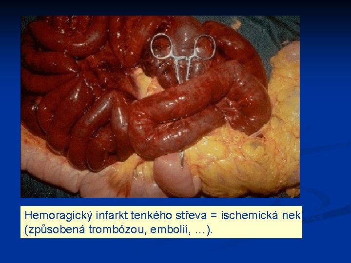 Hemoragický infarkt tenkého střeva = ischemická nekróza (způsobená trombózou, embolií, …). 