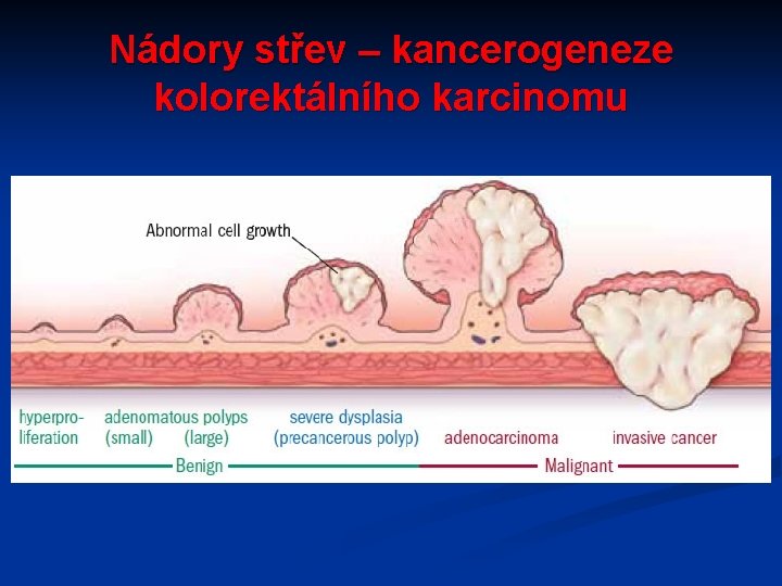Nádory střev – kancerogeneze kolorektálního karcinomu 