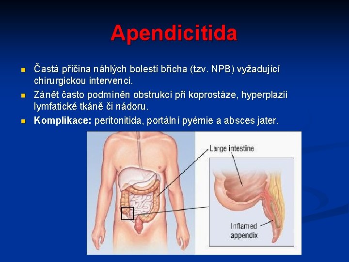 Apendicitida n n n Častá příčina náhlých bolestí břicha (tzv. NPB) vyžadující chirurgickou intervenci.