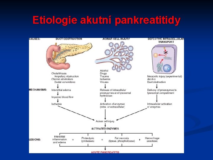 Etiologie akutní pankreatitidy 