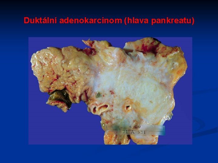 Duktální adenokarcinom (hlava pankreatu) 