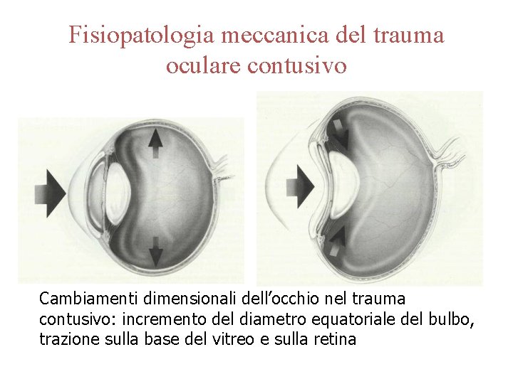Fisiopatologia meccanica del trauma oculare contusivo Cambiamenti dimensionali dell’occhio nel trauma contusivo: incremento del