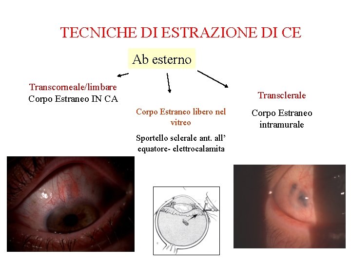 TECNICHE DI ESTRAZIONE DI CE Ab esterno Transcorneale/limbare Corpo Estraneo IN CA Transclerale Corpo