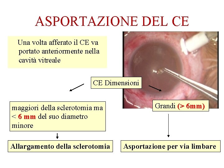 ASPORTAZIONE DEL CE Una volta afferato il CE va portato anteriormente nella cavità vitreale