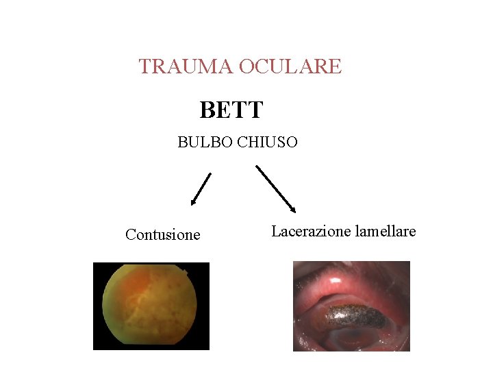 TRAUMA OCULARE BETT BULBO CHIUSO Contusione Lacerazione lamellare 