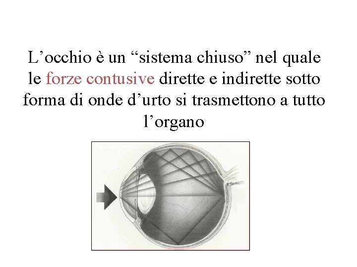 L’occhio è un “sistema chiuso” nel quale le forze contusive dirette e indirette sotto