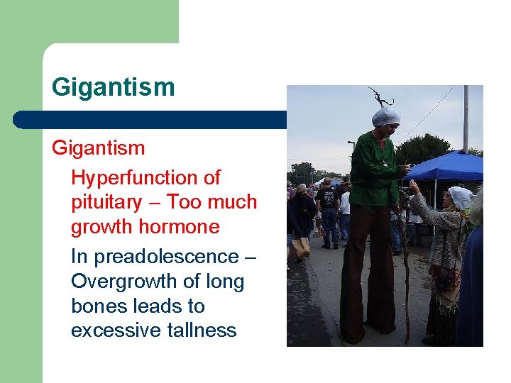 Gigantism Hyperfunction of pituitary – Too much growth hormone In preadolescence – Overgrowth of