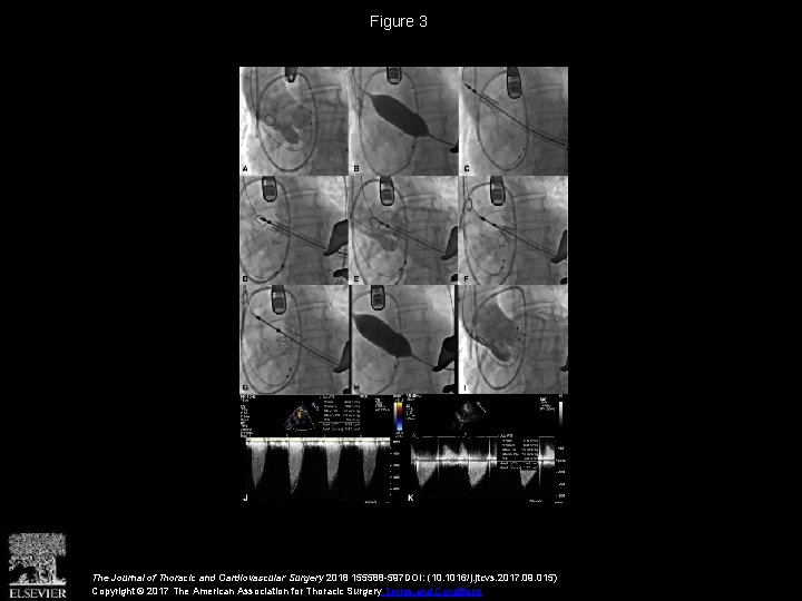 Figure 3 The Journal of Thoracic and Cardiovascular Surgery 2018 155588 -597 DOI: (10.