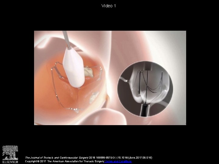 Video 1 The Journal of Thoracic and Cardiovascular Surgery 2018 155588 -597 DOI: (10.
