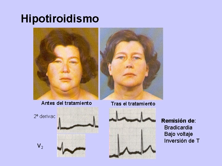 Hipotiroidismo Antes del tratamiento 2ª derivac V 2 Tras el tratamiento Remisión de: Bradicardia