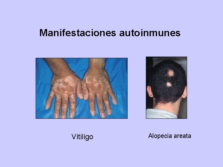 Manifestaciones autoinmunes Vitiligo Alopecia areata 