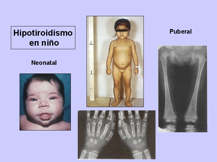 Hipotiroidismo en niño Neonatal Puberal 