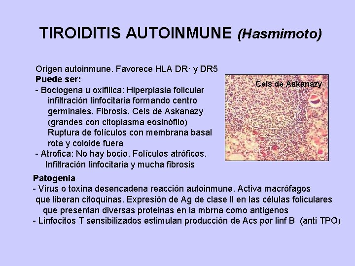 TIROIDITIS AUTOINMUNE (Hasmimoto) Origen autoinmune. Favorece HLA DR· y DR 5 Puede ser: -