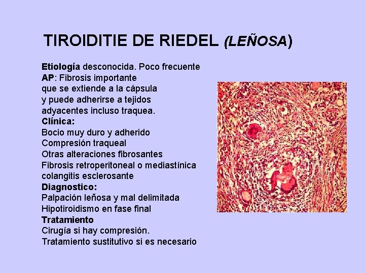 TIROIDITIE DE RIEDEL (LEÑOSA) Etiología desconocida. Poco frecuente AP: Fibrosis importante que se extiende