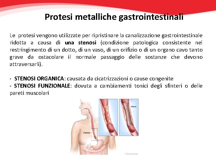 Protesi metalliche gastrointestinali Le protesi vengono utilizzate per ripristinare la canalizzazione gastrointestinale ridotta a