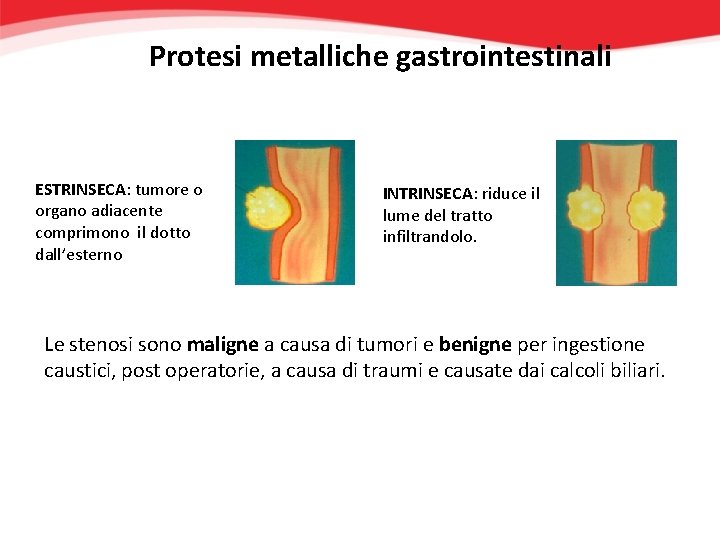 Protesi metalliche gastrointestinali ESTRINSECA: tumore o organo adiacente comprimono il dotto dall’esterno INTRINSECA: riduce