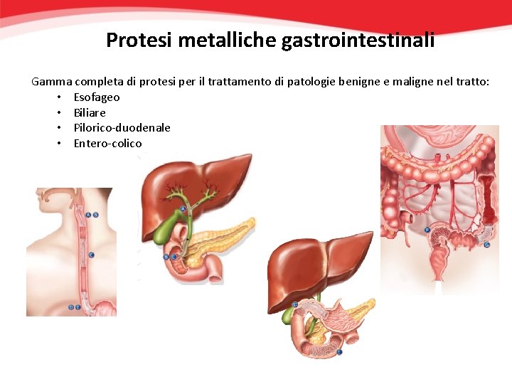 Protesi metalliche gastrointestinali Gamma completa di protesi per il trattamento di patologie benigne e