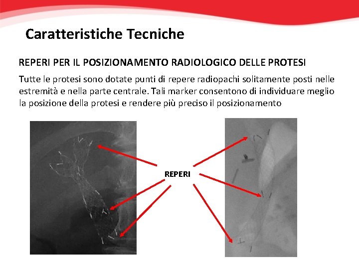 Caratteristiche Tecniche REPERI PER IL POSIZIONAMENTO RADIOLOGICO DELLE PROTESI Tutte le protesi sono dotate