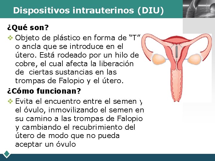 Dispositivos intrauterinos (DIU) ¿Qué son? v Objeto de plástico en forma de “T” o