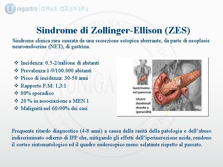 Sindrome di Zollinger-Ellison (ZES) Sindrome clinica rara causata da una secrezione ectopica aberrante, da