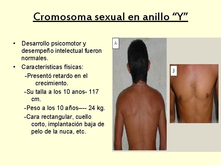 Cromosoma sexual en anillo “Y” • Desarrollo psicomotor y desempeño intelectual fueron normales. •