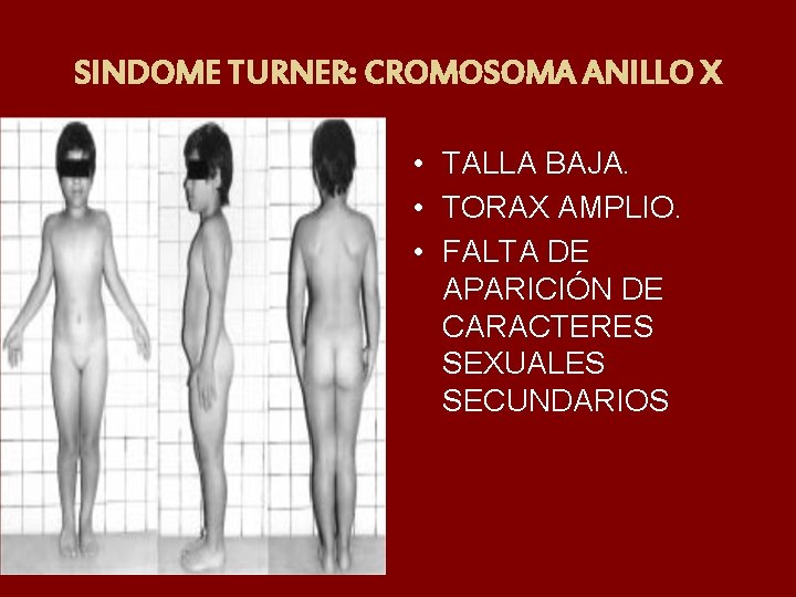 SINDOME TURNER: CROMOSOMA ANILLO X • TALLA BAJA. • TORAX AMPLIO. • FALTA DE