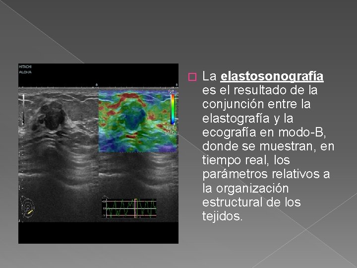 � La elastosonografía es el resultado de la conjunción entre la elastografía y la