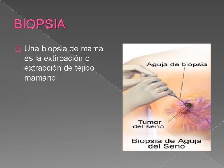 BIOPSIA � Una biopsia de mama es la extirpación o extracción de tejido mamario