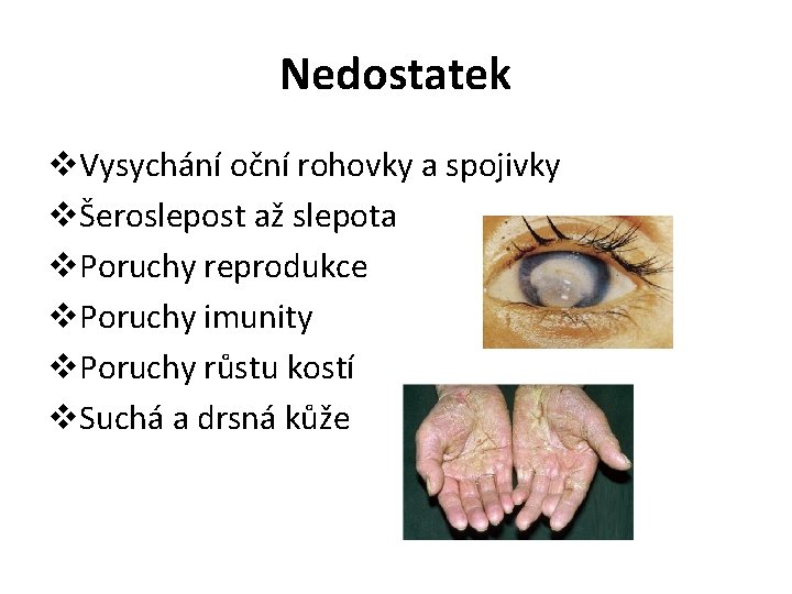 Nedostatek v. Vysychání oční rohovky a spojivky vŠeroslepost až slepota v. Poruchy reprodukce v.