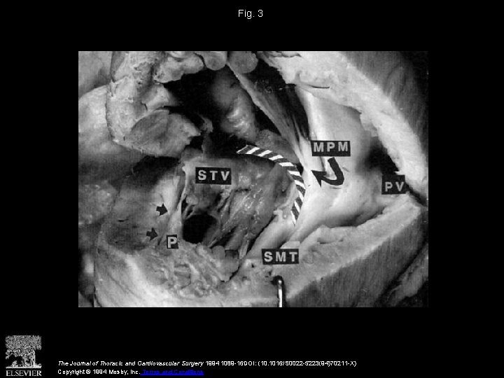 Fig. 3 The Journal of Thoracic and Cardiovascular Surgery 1994 1089 -16 DOI: (10.