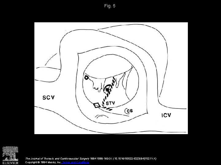 Fig. 5 The Journal of Thoracic and Cardiovascular Surgery 1994 1089 -16 DOI: (10.
