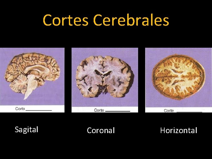 Cortes Cerebrales Sagital Coronal Horizontal 