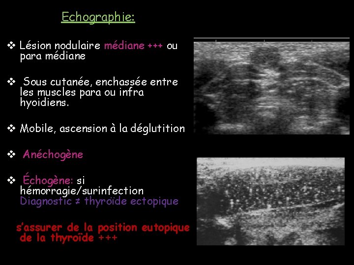 Echographie: v Lésion nodulaire médiane +++ ou para médiane v Sous cutanée, enchassée entre Echographie: v Lésion nodulaire médiane +++ ou para médiane v Sous cutanée, enchassée entre
