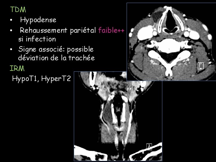 TDM • Hypodense • Rehaussement pariétal faible++ si infection • Signe associé: possible déviation TDM • Hypodense • Rehaussement pariétal faible++ si infection • Signe associé: possible déviation