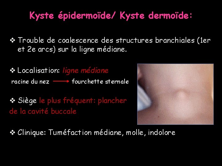 Kyste épidermoïde/ Kyste dermoïde: v Trouble de coalescence des structures branchiales (1 er et Kyste épidermoïde/ Kyste dermoïde: v Trouble de coalescence des structures branchiales (1 er et