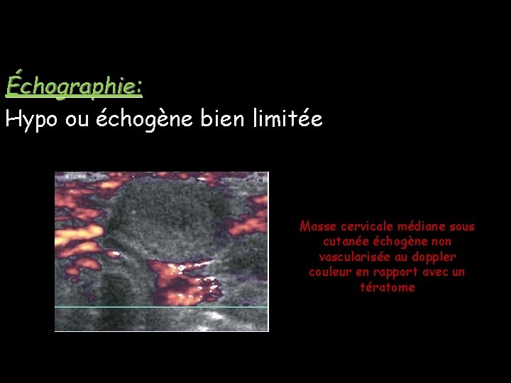 Échographie: Hypo ou échogène bien limitée Masse cervicale médiane sous cutanée échogène non vascularisée Échographie: Hypo ou échogène bien limitée Masse cervicale médiane sous cutanée échogène non vascularisée