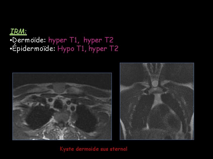 IRM: • Dermoïde: hyper T 1, hyper T 2 • Épidermoïde: Hypo T 1, IRM: • Dermoïde: hyper T 1, hyper T 2 • Épidermoïde: Hypo T 1,