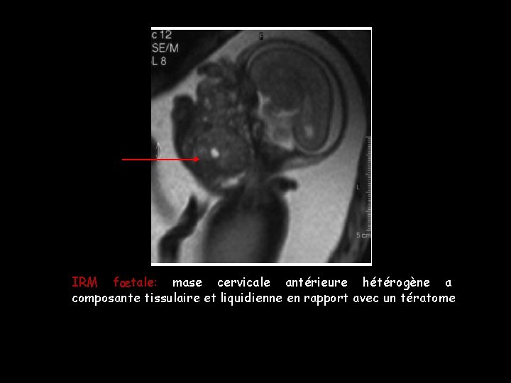 IRM fœtale: mase cervicale antérieure hétérogène a composante tissulaire et liquidienne en rapport avec IRM fœtale: mase cervicale antérieure hétérogène a composante tissulaire et liquidienne en rapport avec